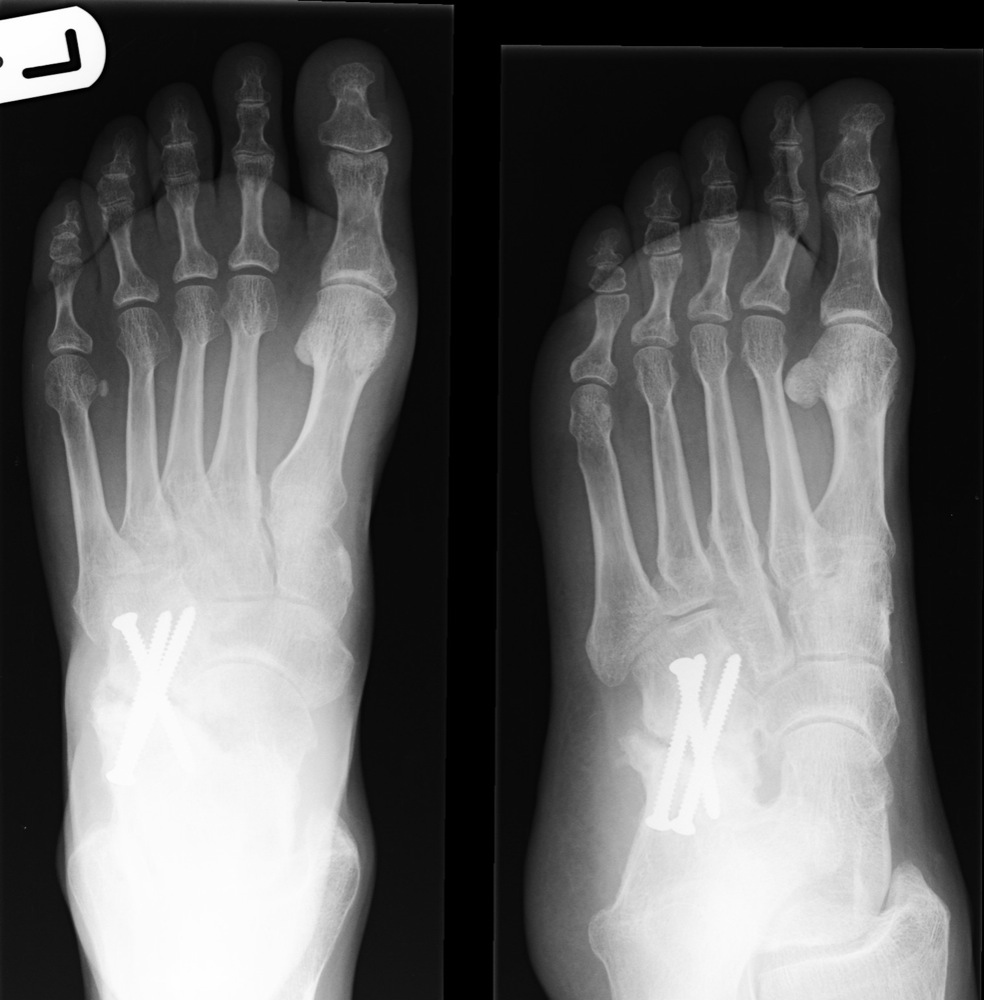 fractured foot bone