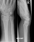 Colles' fracture