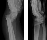 Galeazzi fracture-dislocation