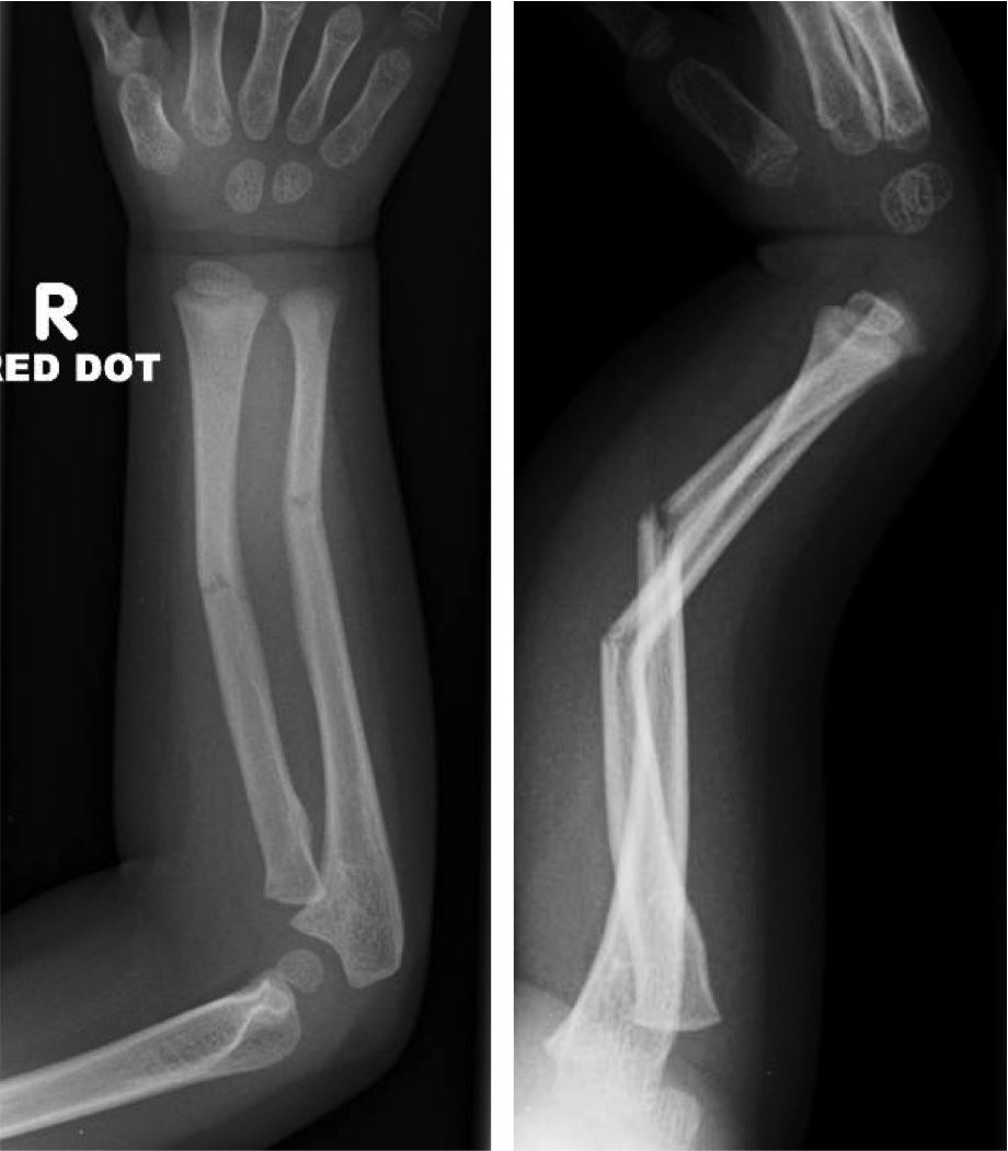 What is a buckle fracture of the wrist?