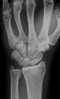 Midcarpal dislocation, fracture radial styloid