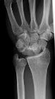 Perilunate dislocation, fracture scaphoid