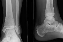 Salter-Harris III (Tillaux fracture) tibial epiphysis