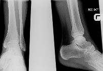 Avulsion anterior process calcaneum