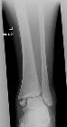 Maisonneuve fracture