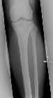 Maisonneuve fracture