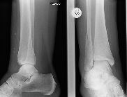 Fracture posterior malleolus, fracture fibula