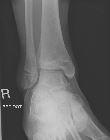 Salter-Harris I fibular growth plate