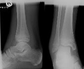 Salter-Harris II fibular metaphysis