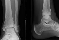 Salter-Harris III (Tillaux fracture) tibial epiphysis