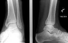 Talar dome fracture