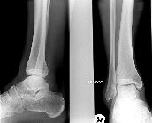 Talar dome fracture