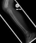 Toddler's fracture