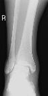 Widening of medial mortise