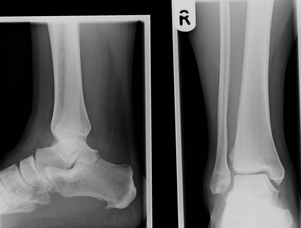 tibia and fibula x ray