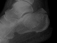 Compression fracture calcaneum