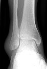Lateral soft tissue swelling, no fracture