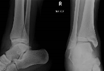 Salter-Harris IV tibial epiphysis and metaphysis