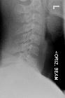 Anterior wedge compression fracture - C7