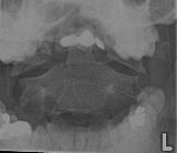 Jefferson burst fracture - C1