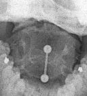 Congenital fusion C2,C3