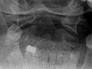 Congenital fusion, hypoplastic peg