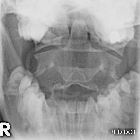 Mach effect due to overlying incisor