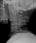 Fracture C2 with spondylosis