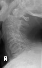 Fracture C2 with spondylosis
