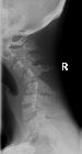 Facet joint dislocation - lateral