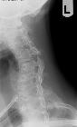 Facet joint dislocation - left oblique