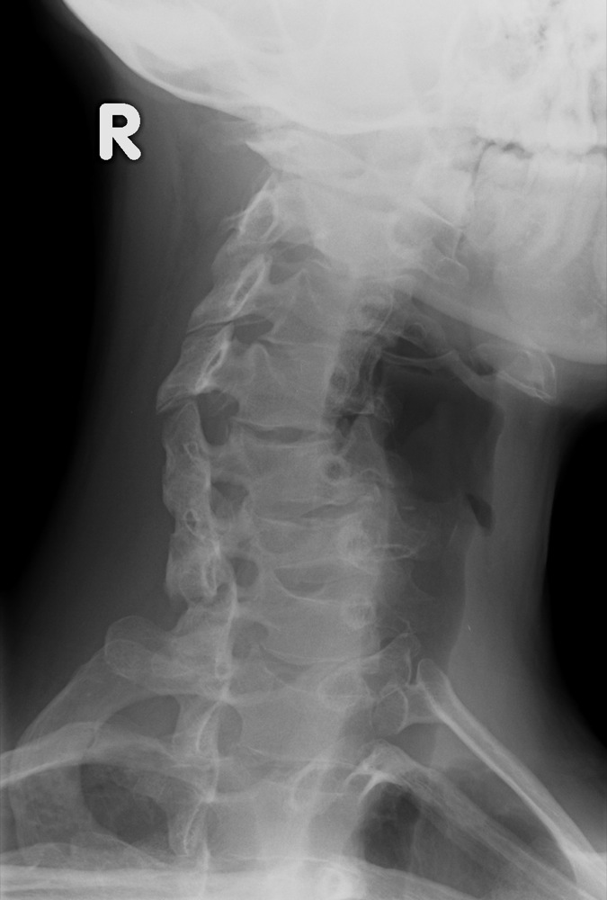 Dislocation of the Cervical Spine