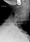 Odontoid peg fracture