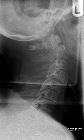 Odontoid peg fracture