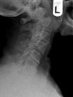 Odontoid peg fracture