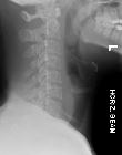 Spinous process fracture - C4
