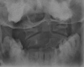 Asymmetric widening due to rotation