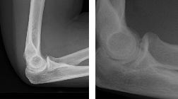 Coronoid process fractures