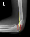 Normal anterior humeral line