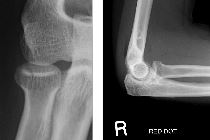 Radial head linear fracture