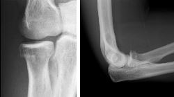 Radial neck fracture