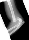 Displaced supracondylar fracture