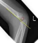 Abnormal anterior humeral line