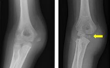 Avulsion medial epicondyle