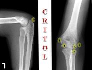 CRITOL ossification centres