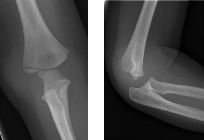 Lateral condyle fracture