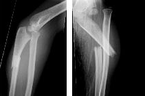 Monteggia fracture-dislocation