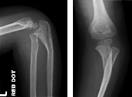 Monteggia fracture-dislocation