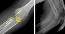 Monteggia fracture-dislocation