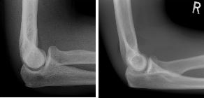 Normal (left), raised posterior fat pad and fracture radial neck (right)